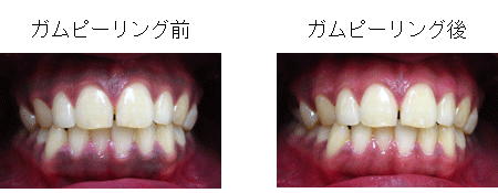 ガムピーリングの施術例