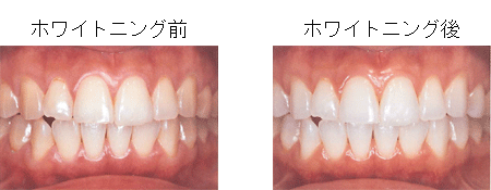 ホワイトニングの施術例